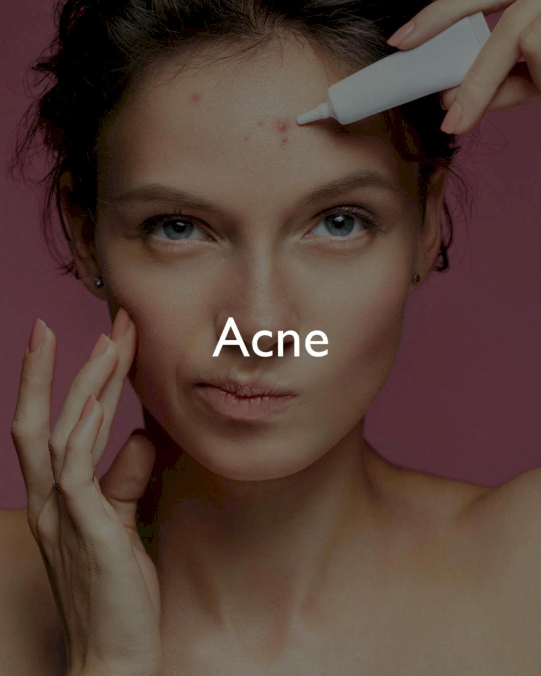 ACNE